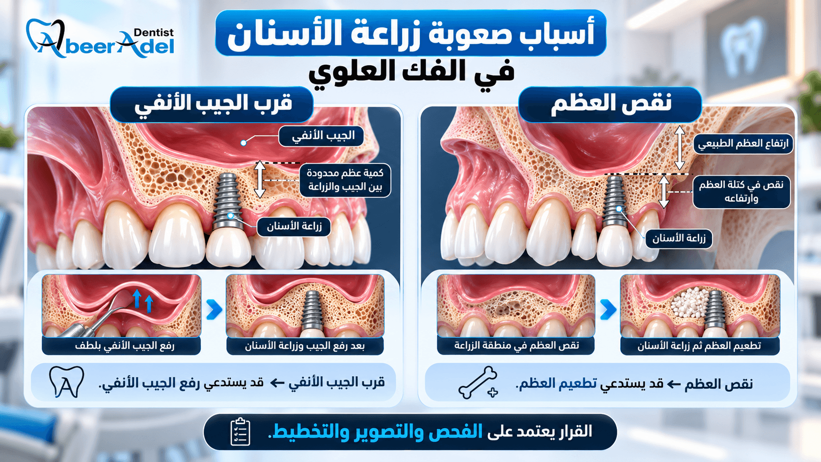 تصميم مقال بيلر